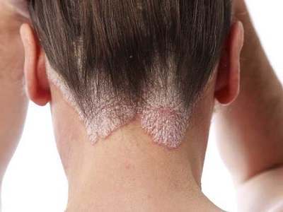 Treating hair loss with tea tree oil